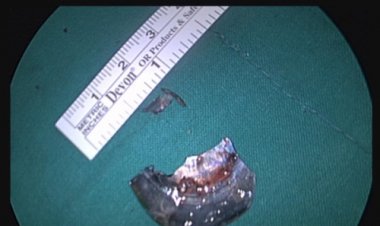 홍합껍데기 조각 목에 걸려 식도 절개수술 성공